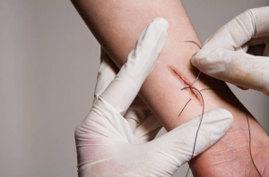 Suture Removal at Home in Gurgaon