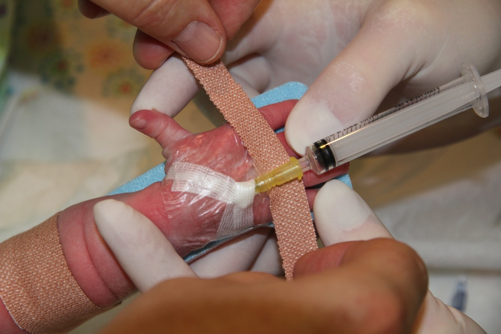 cannula-insertion-at-home-in-gurgaon