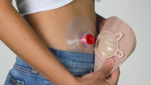 Colostomy Bag Change
