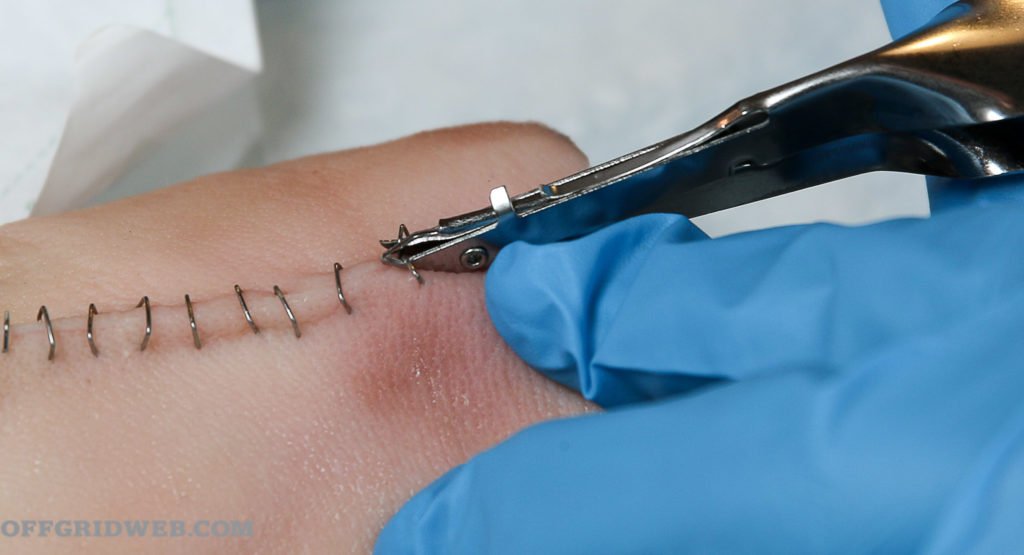 suture-removal-at-home-in-gurgaon